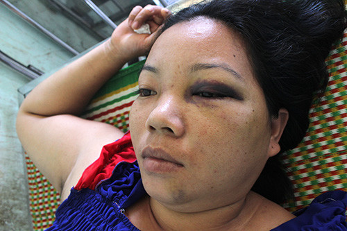 Chị Phượng bị cha con ông Thái đánh bầm tím mặt đang nằm điều trị tại Bệnh viện Tiên Phước. Ảnh: D.L