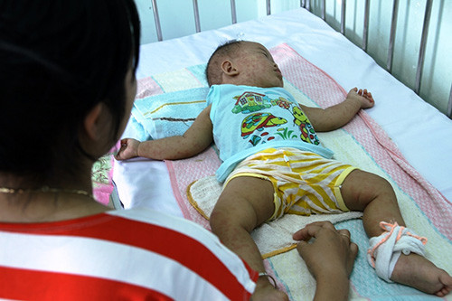 Trẻ mắc bệnh sởi đang được điều trị tại Bệnh viện Nhi Quảng Nam. Ảnh: T.C