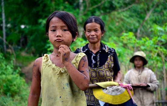 Bé Pơloong Sa với ghẻ mụn khắp người.