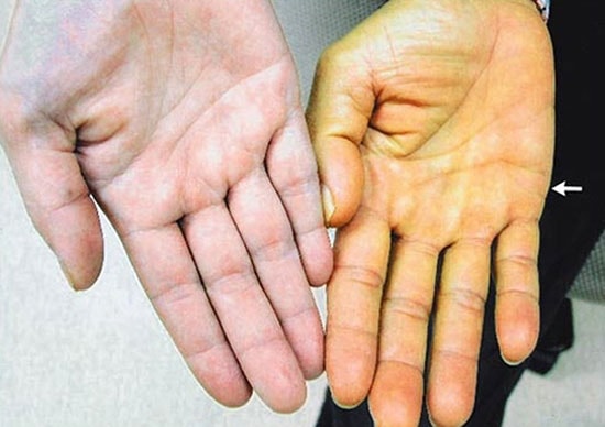 Với số ít những người gan nhiễm mỡ bị vàng da ở thể nhẹ, sau khi chất béo được thanh lọc khỏi gan, triệu chứng này sẽ nhanh chóng biến mất. (Ảnh minh họa).