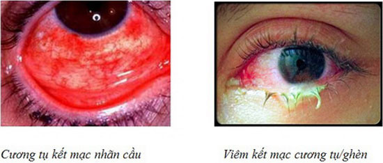 Bệnh đau mắt đỏ gây viêm kết mạc.