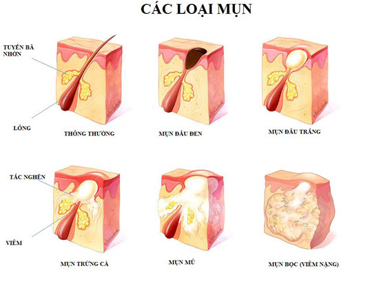 Theo y học cổ truyền, mụn nhọt là do hoả độc gây ra.