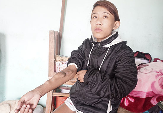 Chị Nguyễn Thị Cẩm Nhung với cánh tay bị chai vên, nổi thành nhiều khối u to. Ảnh: NHƯ TRANG