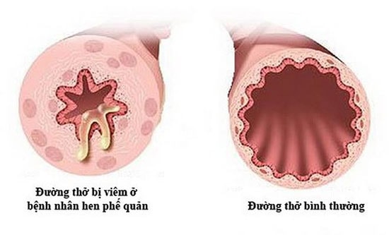 Cấu trúc phế quản của người hen so với người bình thường.