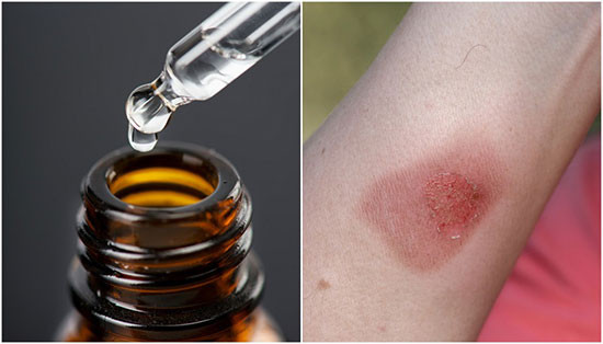Dùng tinh dầu nguyên chất bôi trực tiếp lên da có thể gây bỏng