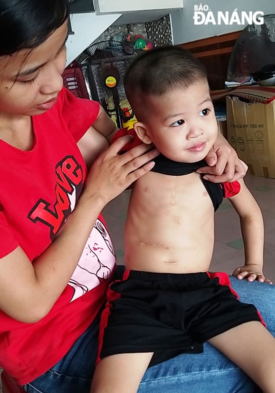 Cháu Lê Đắc Nhân với vết mổ ở giữa bụng sau 3 lần phẫu thuật.   Ảnh: Y.GIANG