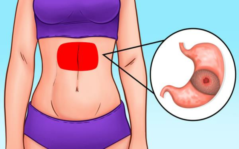 Đau dữ dội vùng bụng trên: Tình trạng này xảy ra khi dạ dày chịu tổn thương quá nhiều trong thời gian dài gây loét. Các triệu chứng đi kèm của bệnh này có thể là thay đổi khẩu vị, buồn nôn, đại tiện ra máu...