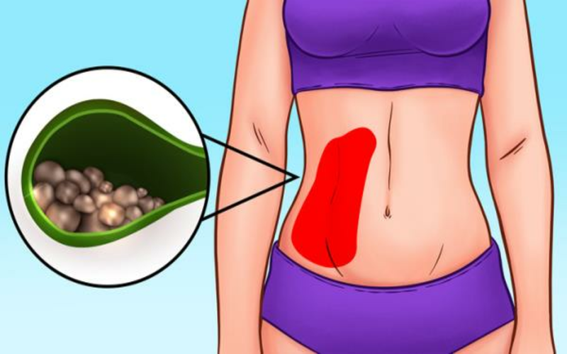 Đau dữ dội vùng trên bên phải bụng: Tình trạng trên xảy ra khi viên sỏi bị mắc vào một trong những đường ống dấn nước từ gan đến ruột non, báo hiệu của bệnh sỏi mật.