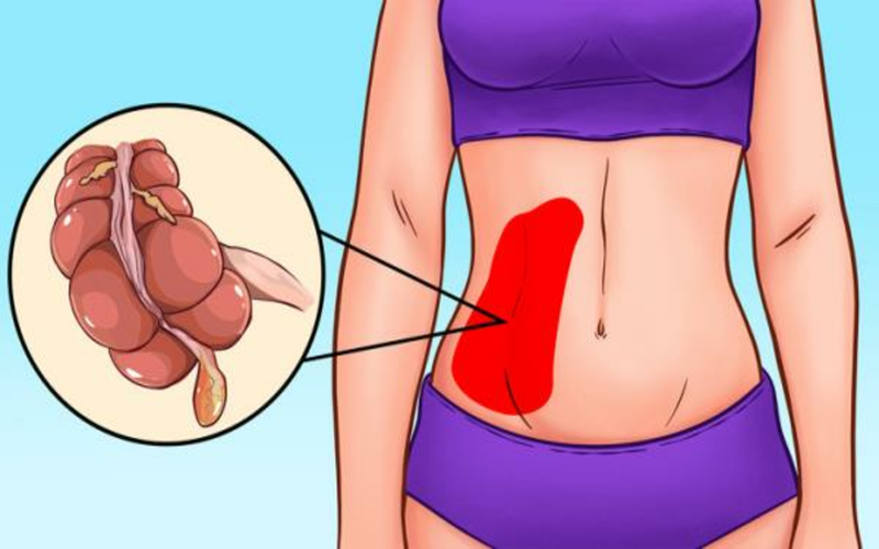 Đau bụng dưới bên phải: Nếu có triệu chứng này thì rất có thể bạn đang bị viêm ruột thừa. Triệu chứng đi kèm có thể là đau nhói vùng gần rốn hoặc bụng bên phải, phình bụng, sốt cao.
