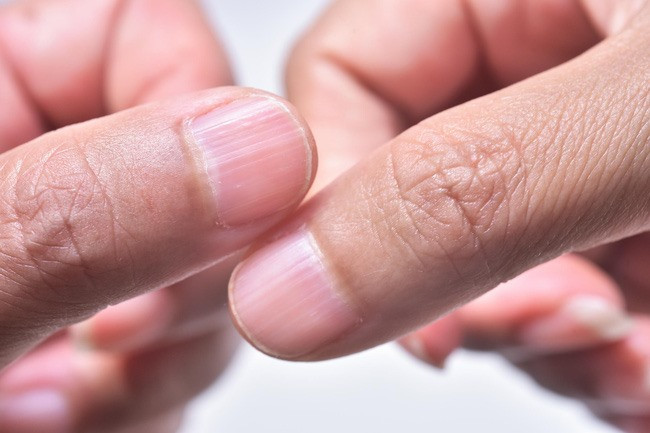 Móng tay có những rạch dài là dấu hiệu cảnh báo cơ thể quá thiếu chất lưu huỳnh.