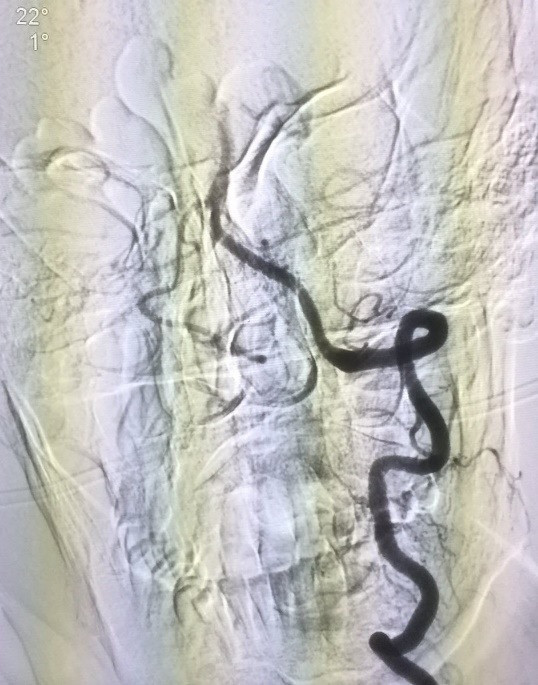 Bệnh nhân tắc hoàn toàn động mạch thân nền (ảnh trên) và sau can thiệp, động mạch thân nền được tái thông hoàn toàn  (ảnh dưới). ảnh: T.L