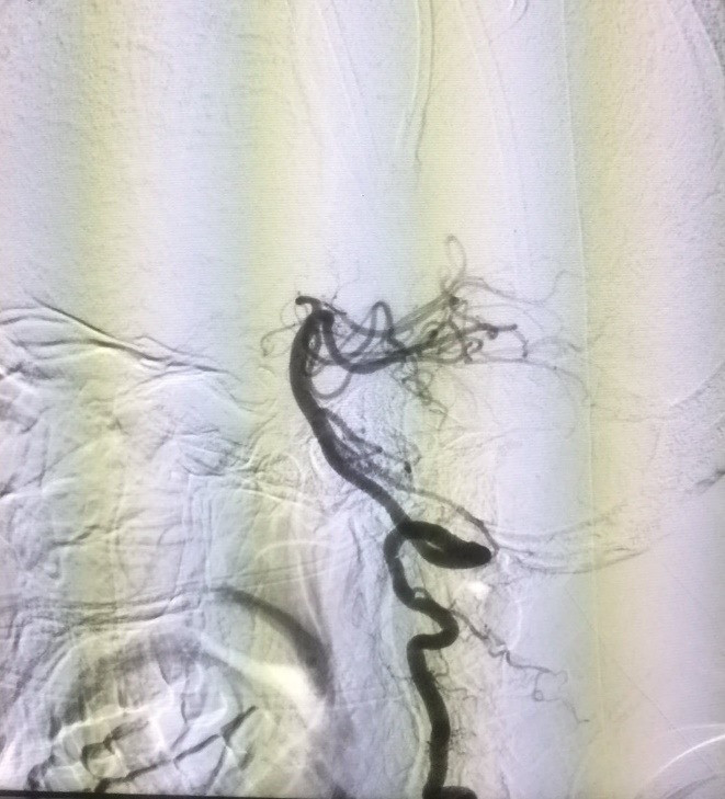 Bệnh nhân tắc hoàn toàn động mạch thân nền (ảnh trên) và sau can thiệp, động mạch thân nền được tái thông hoàn toàn  (ảnh dưới). ảnh: T.L