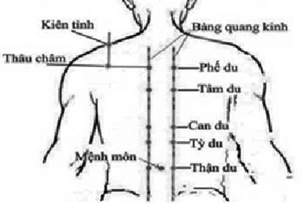 Một số huyệt tại chỗ sử dụng điều trị chắp lẹo.