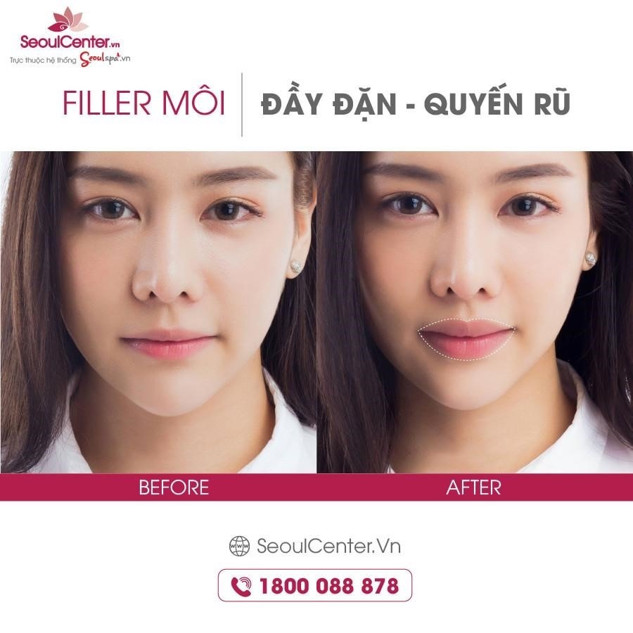 Ảnh thực tế của khách hàng sau khi tiêm filler môi tại Seoul Center.