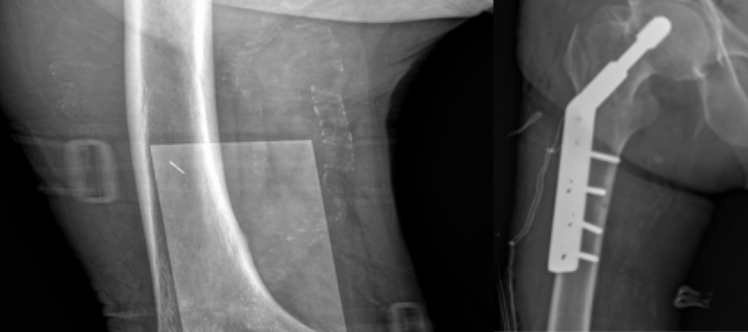 Xương đùi của bệnh nhân (phải) trước và sau khi kết hợp xương