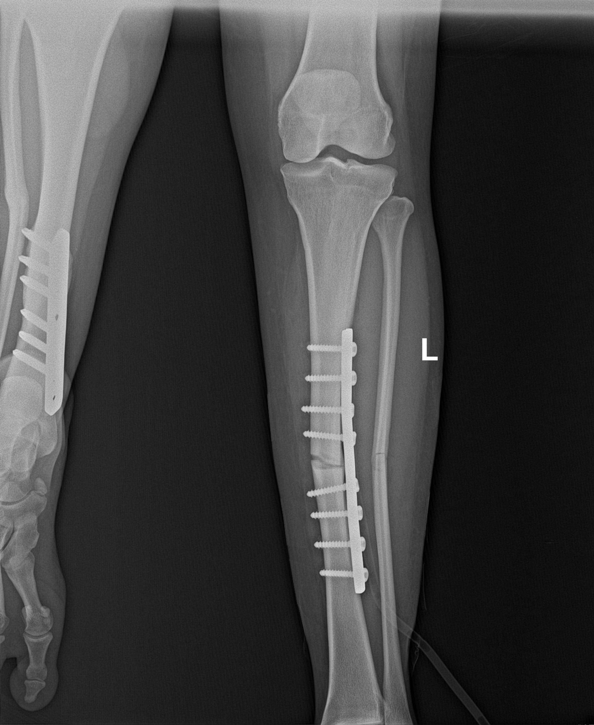Hình ảnh X.quang của bệnh nhân sau phẫu thuật.