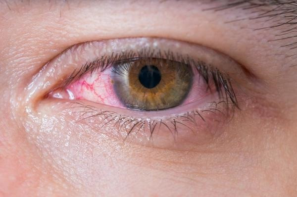 Đau mắt đỏ là căn bệnh dễ mắc sau mưa lũ.