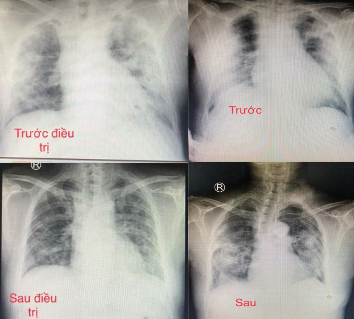 Hình ảnh chụp X-quang của một vài bệnh nhân trước và sau điều trị. Ảnh: T.T.PHONG