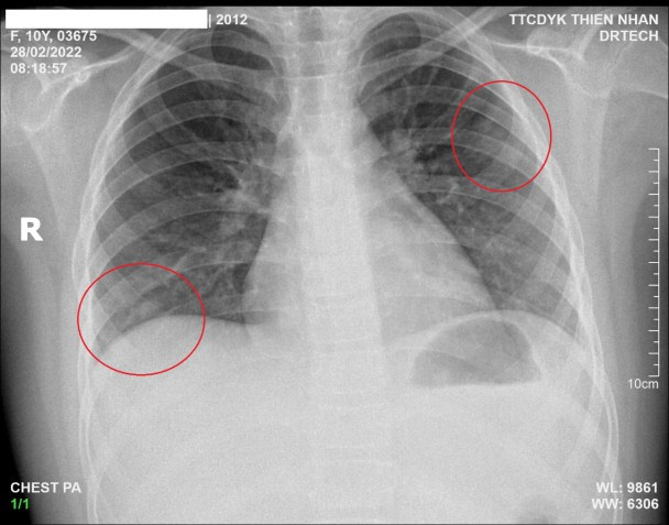 Nhiều bệnh nhân tổn thương phổi sau Covid-19.