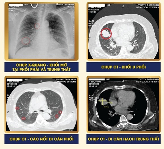 Hình ảnh X.quang và CT bệnh nhân cho thấy rõ 2 khối u phổi. Ảnh: T.N