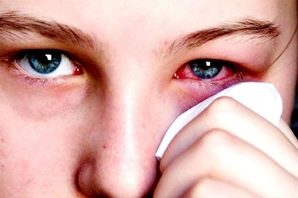 Bệnh đau mắt đỏ nên được thăm khám và điều trị sớm.