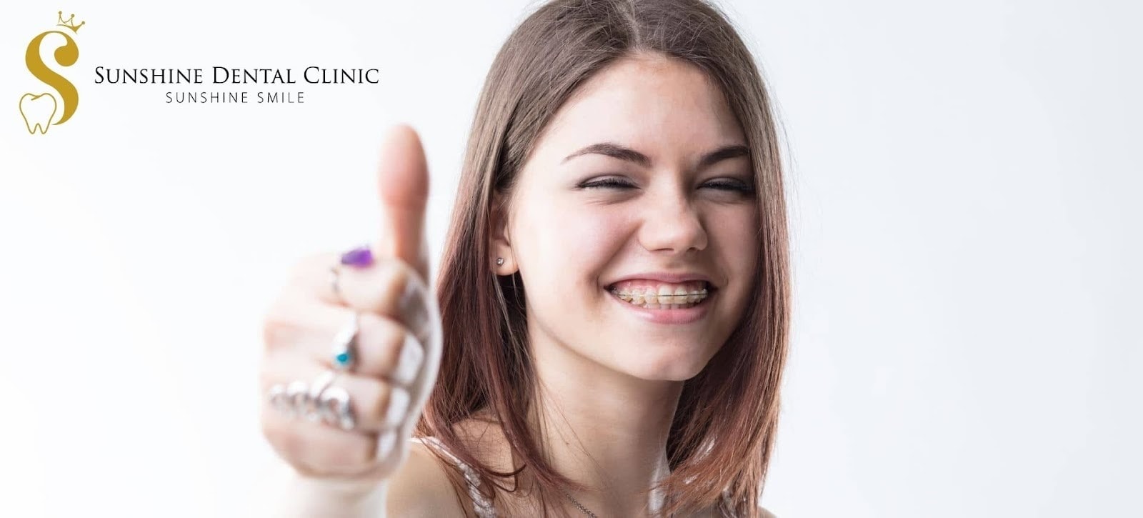 Niềng răng mắc cài sứ uy tín tại Sunshine Dental Clinic.