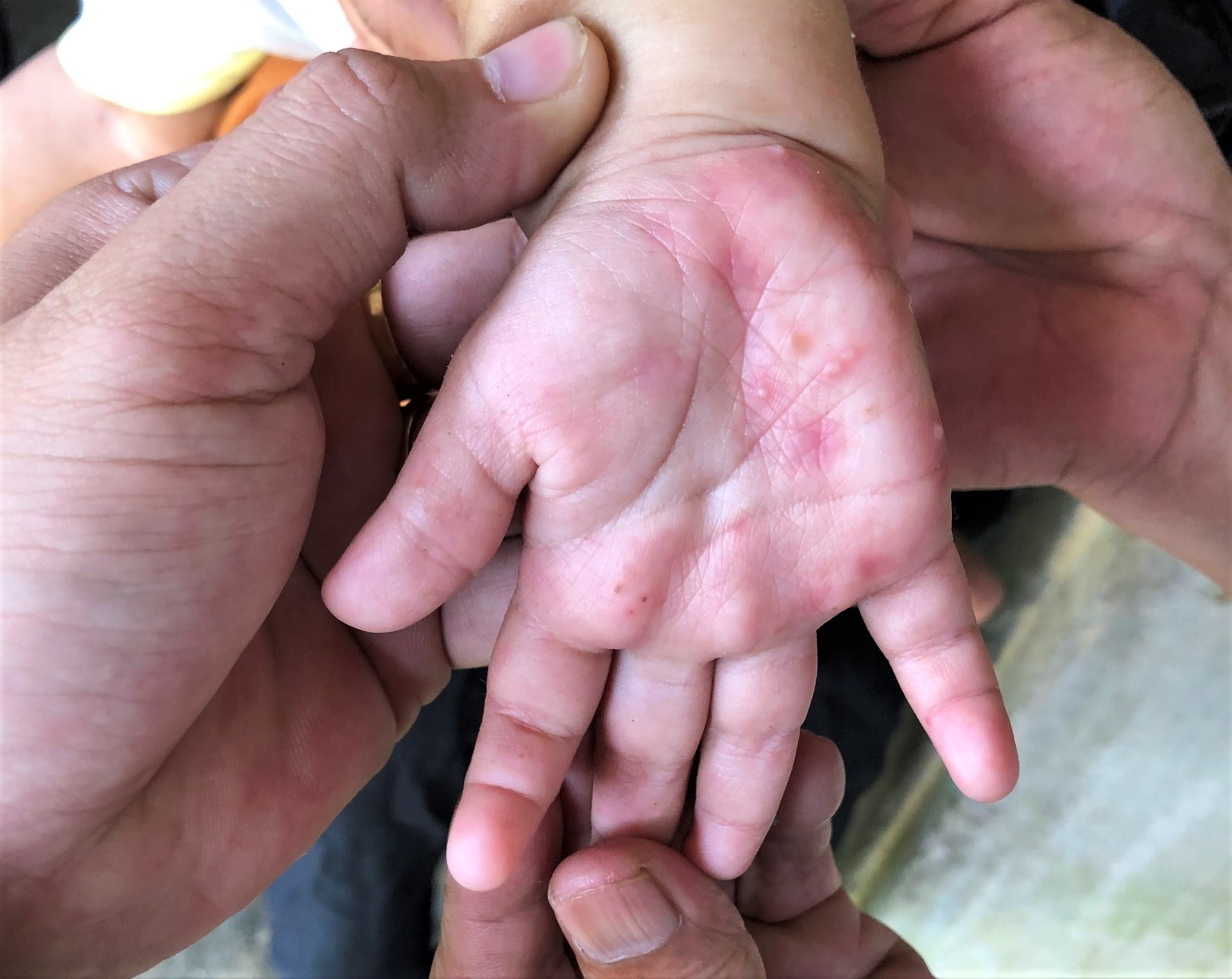 Bàn tay của một bệnh nhân nhi tại thôn 1, xã Trà Nú với triệu chứng viêm da, ghẻ bội nhiễm, nhiều mụn nước.