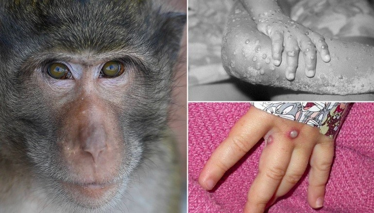 Tới thời điểm 18/7/2022, WHO không khuyến cáo việc tiêm vaccine phòng, chống bệnh đậu mùa khỉ rộng rãi do virus đậu mùa khỉ không dễ dàng lây lan.