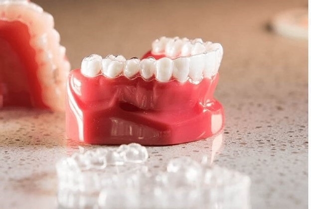 Thời gian niềng răng trong suốt trung bình từ 1 đến 2 năm.