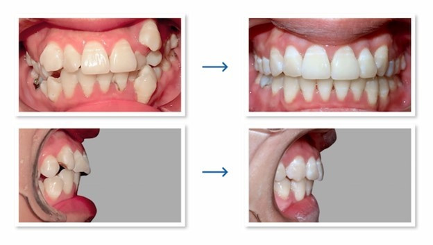 Nếu răng gặp các vấn đề như khấp khểnh, sai lệch ít thì thời gian niềng răng ngắn.