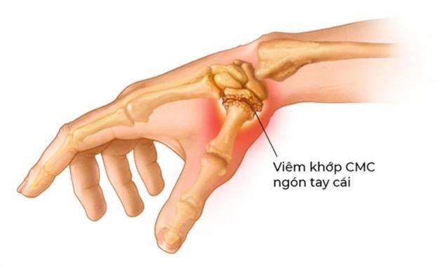 Hình ảnh khớp ngón tay cái bị tổn thương