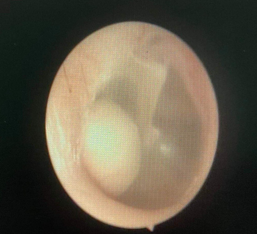 Hình ảnh khối Cholesteatoma khi chụp CT