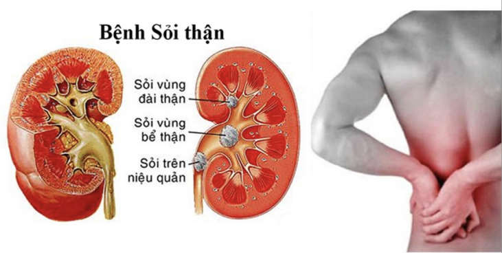 Mất nước là một trong những yếu tố nguy cơ chính gây sỏi thận