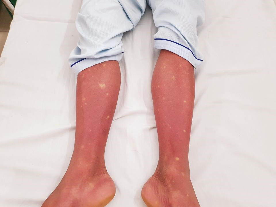 Bệnh nhân bị phát ban trên da từ 2-5 ngày sau khi sốt cao.