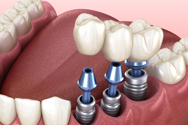 Trụ Implant tích hợp vào xương hàm, có vai trò thay thế chân răng thật và nâng đỡ mão răng.