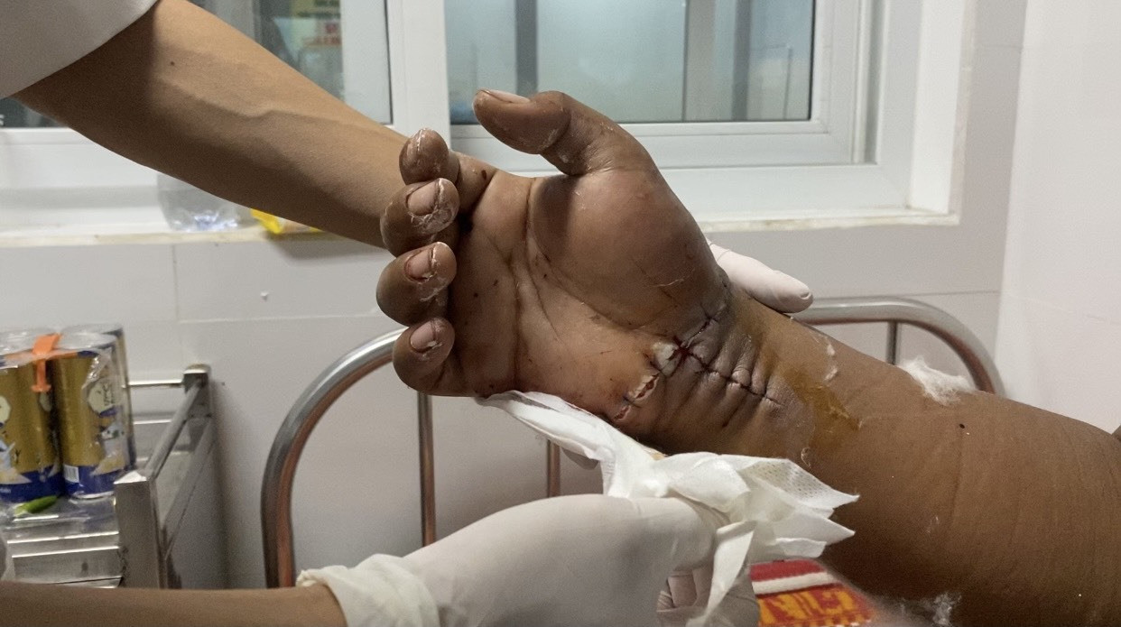 Bàn tay bệnh nhân được cứu sống sau 5 giờ liền được phẫu thuật. Ảnh: N.G
