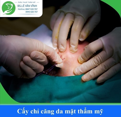 Căng da mặt bằng chỉ vàng 24k mang lại hiệu quả thẩm mỹ lâu dài.