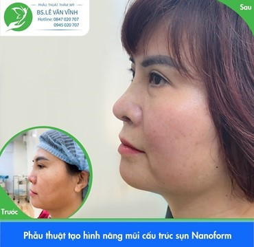 Nâng mũi Nanoform sử dụng chất liệu sụn nhân tạo có độ tương thích cao với cơ thể.