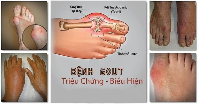 Cơn gout cấp tính xuất hiện đột ngột ban đêm, khiến người bệnh thức dậy vì đau ở khớp.