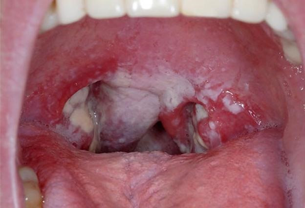 Giả mạc hai bên thành họng, có màu trắng ngà là triệu chứng của bệnh bạch hầu.