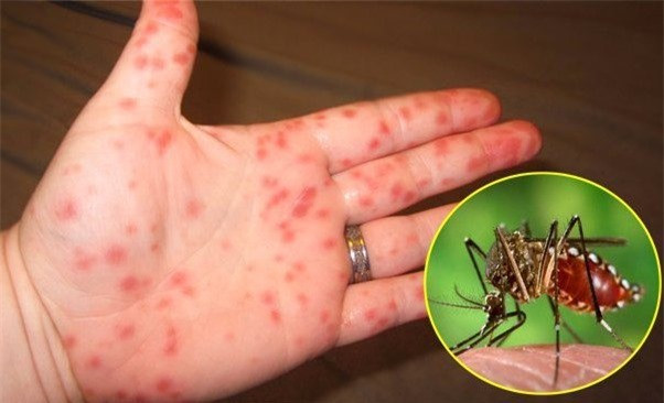 Sốt xuất huyết là bệnh truyền nhiễm cấp tính, có thể gây thành dịch do virus dengue gây ra. Nguồn ảnh: Internet