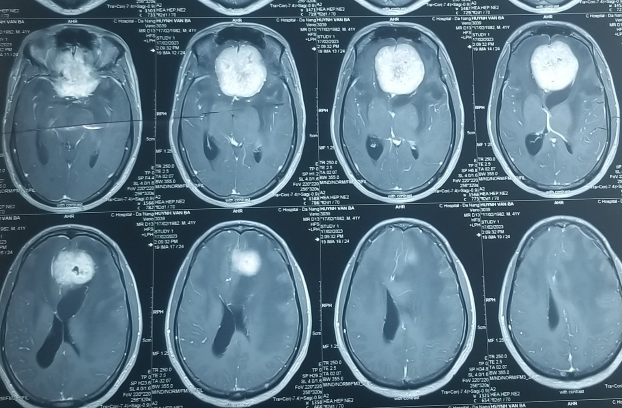 MRI sọ não trước mổ cho thấy khối u vùng trán kích thước 6x6x5 cm chèn ép gây  phù não diện rộng. Ảnh: BVCC