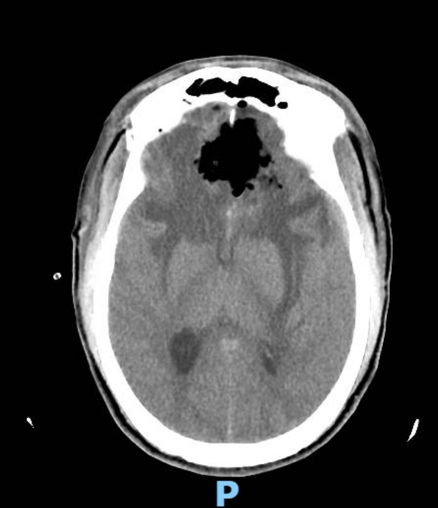 Hình ảnh sọ não sau phẫu thuật cho thấy khối u đã được loại bỏ hoàn toàn. Ảnh: BVCC