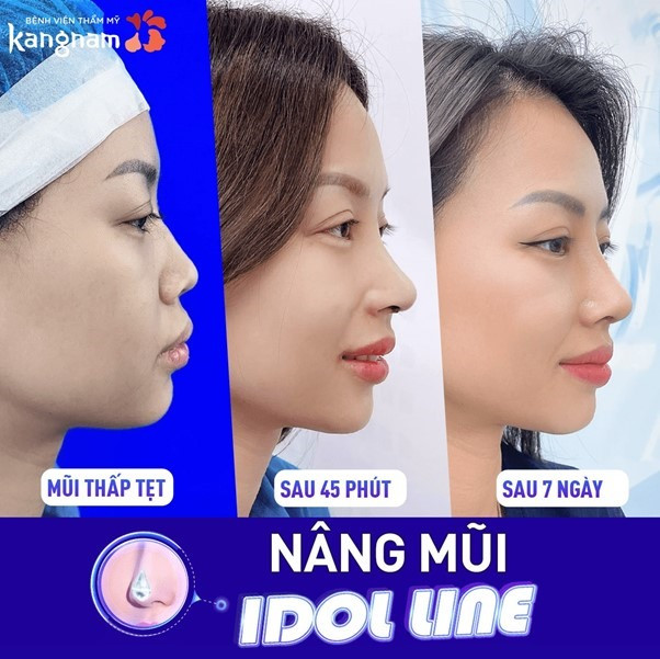 Nâng mũi cấu trúc Idol Line đem tới dáng mũi đẹp như siêu sao xứ Hàn