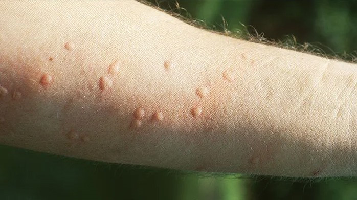 Khi bị kiến cắn bạn cảm thấy vùng da nổi mẩn đỏ, đau và ngứa (Ảnh: Everydayhealth)