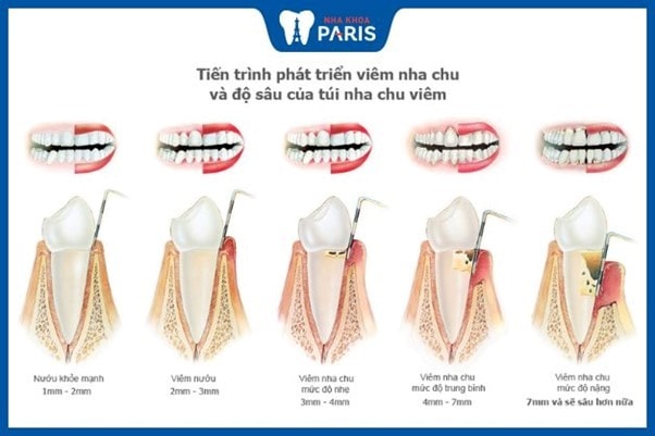 Quá trình phát triển của bệnh viêm nha chu.