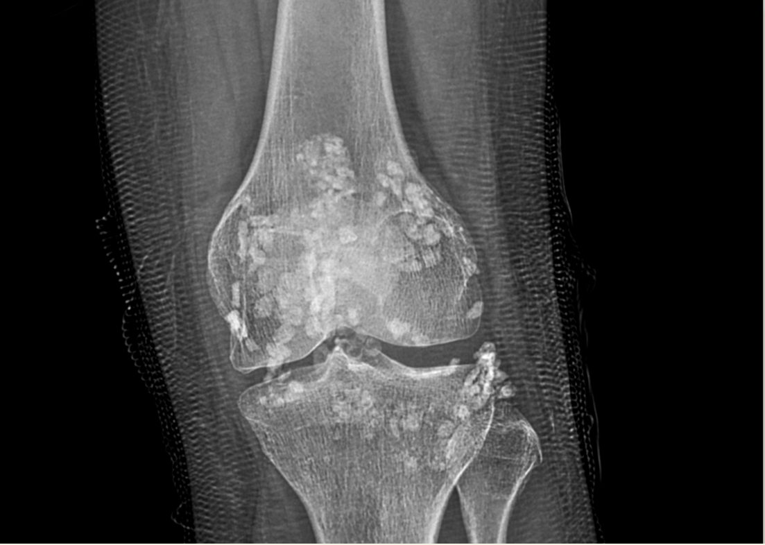Hình ảnh X quang cho thấy khớp gối bệnh nhân chứa đầy các nốt vôi hóa