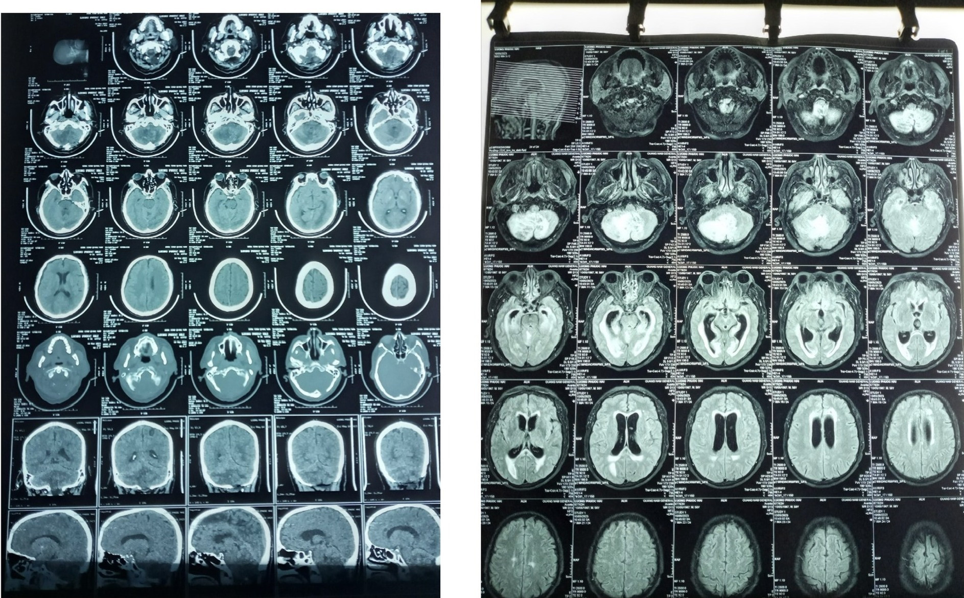 Hình ảnh MRI sọ não bệnh nhân trước và sau phẫu thuật. Ảnh: T.A