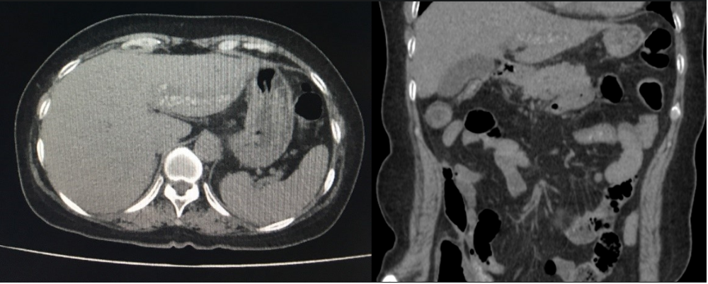 Hình ảnh sỏi lấp đầy đường mật trong gan trên CT scan ổ bụng của bà H.T.L