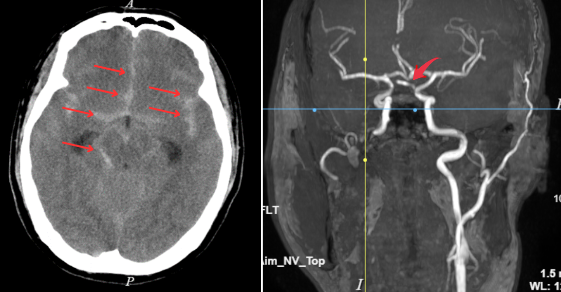 Kết quả chụp CT (hình bên trái) cho thấy hình ảnh xuất huyết dưới nhện. Nguyên nhân do vỡ phình động mạch thông trước, được phát hiện qua kết quả MRI (hình bên phải).